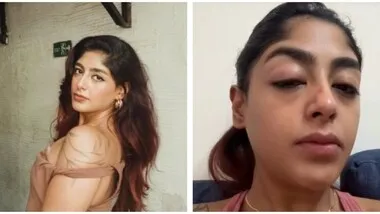 एक्ट्रेस संग भरे क्लब में हुई मारपीट, टूटे दांत-सूजी आंखें और चेहरा