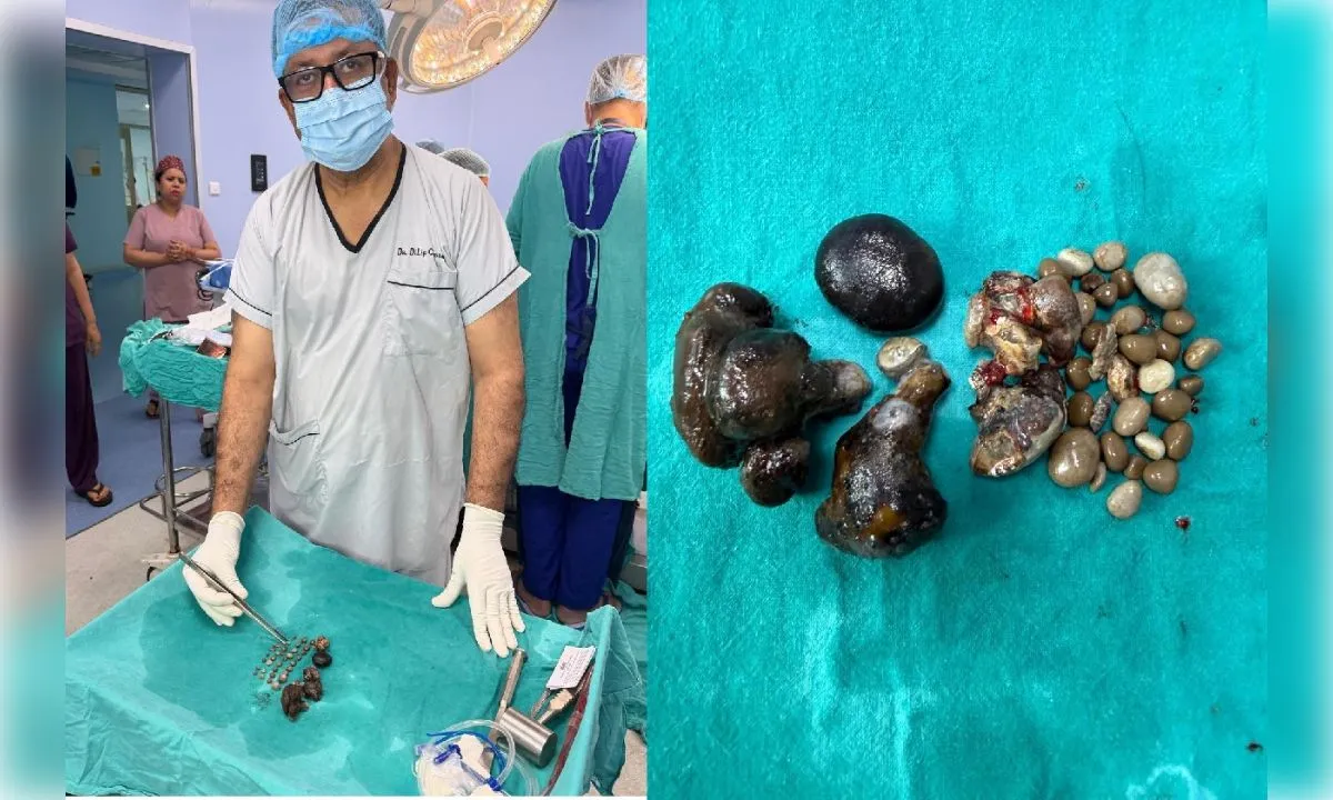 एसआरएन अस्पताल में जटिल ऑपरेशन, किडनी से निकालीं 37 पथरियां