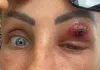 खून चूसता रहा महिला के आंखों से  पैरासाइट? 