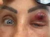 खून चूसता रहा महिला के आंखों से  पैरासाइट? 