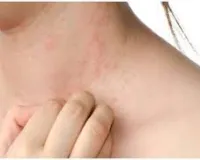 घमोरियों से कैसे छुटकारा पाएं? ये घरेलू नुस्खे आ सकते हैं काम